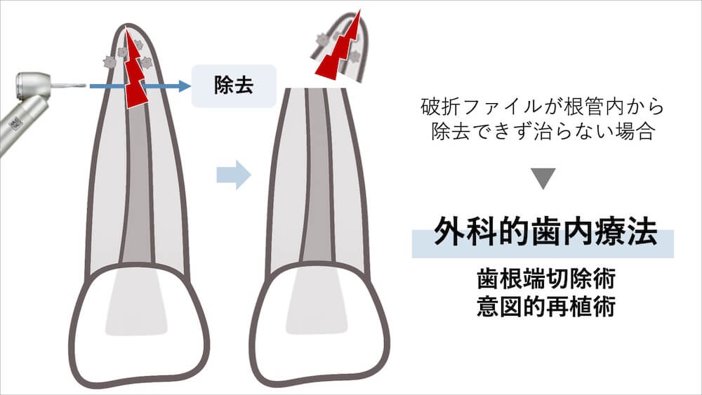 除去できない場合の選択肢
