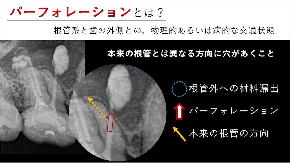 パーフォレーション