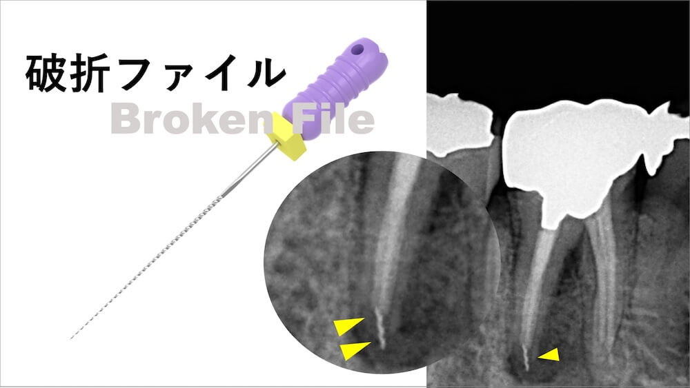破折ファイルとは|根管治療で起こる器具の破折