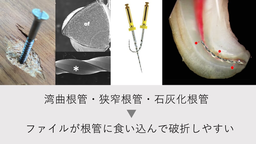 根管の解剖学的形態による破折