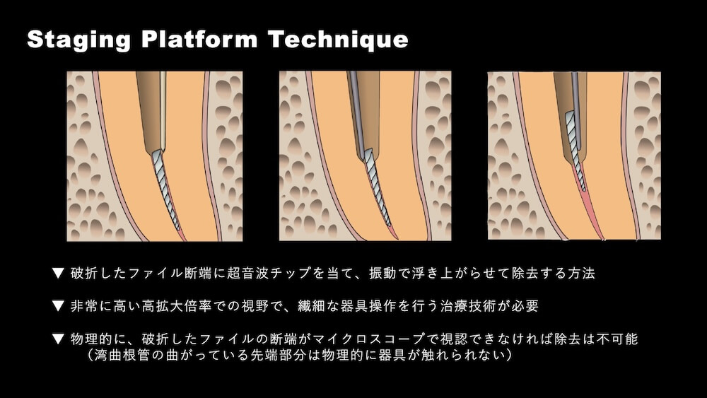 超音波チップによる除去