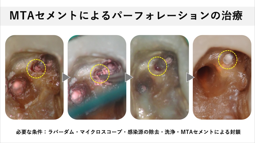 穴をふさぐ材料を適切に選択する
