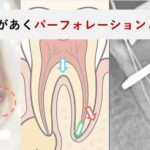 パーフォレーション（穿孔）とは？根管治療中に「歯に穴があいた」と言われた方へ｜原因・症状・治療と予後