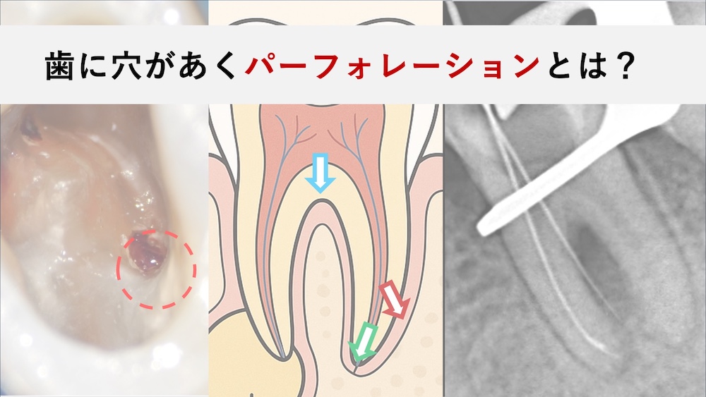パーフォレーション（穿孔）とは？根管治療中に「歯に穴があいた」と言われた方へ｜原因・症状・治療と予後