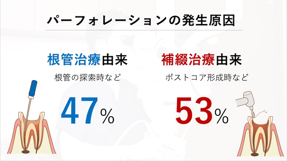 治療中の「偶発的な穿孔」は、どのタイミングでも起こり得る