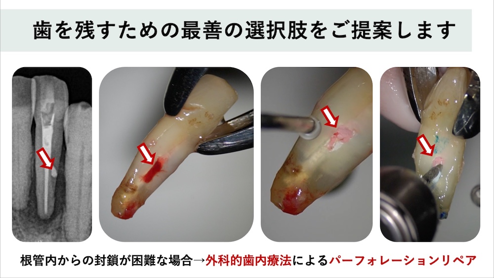 場合によっては外科的な方法を検討する