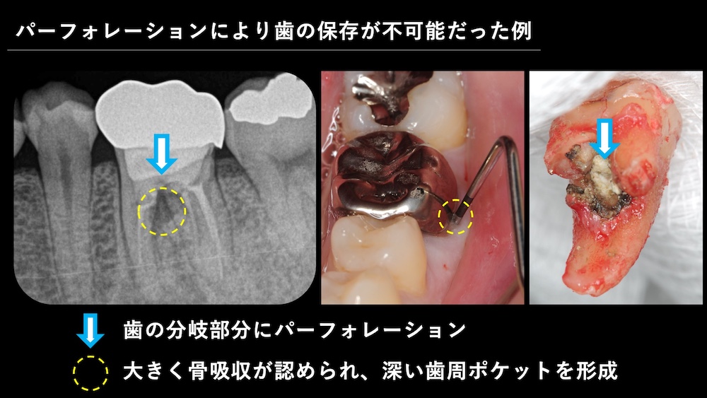 歯そのもののダメージが原因で穴があくこともある