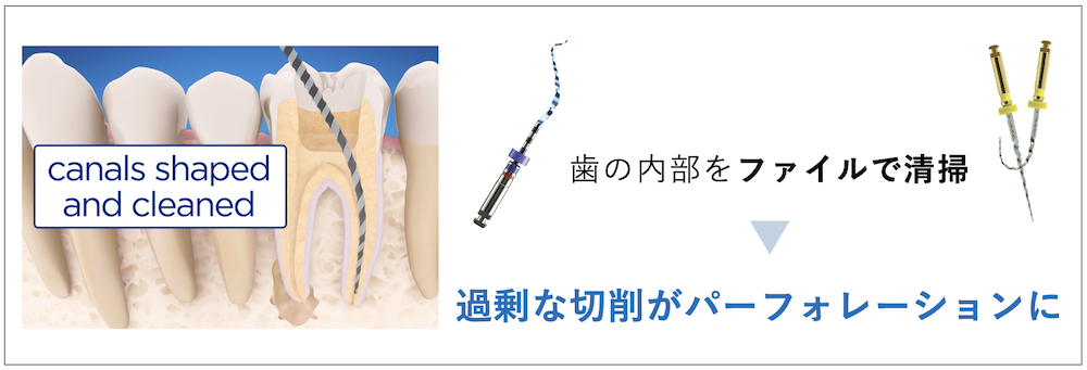 ストリップパーフォレーション