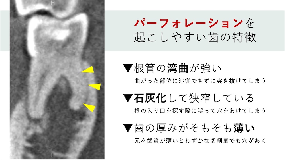 パーフォレーションが起こりやすい歯・条件