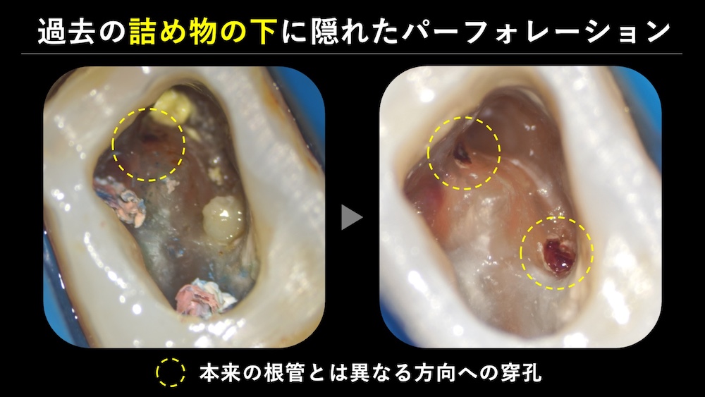 根管治療のやり直しの際はよりリスクが上がる