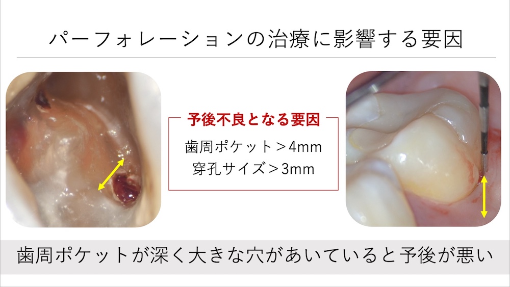 抜歯が妥当だと思われるケース