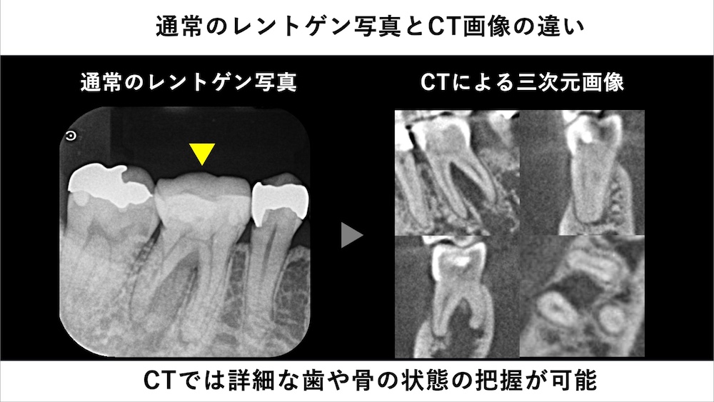 歯科用CTで分かること