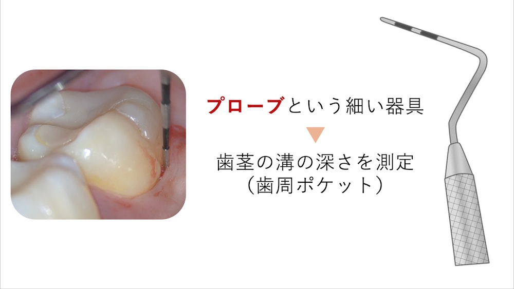 歯ぐきの状態のチェックも重要