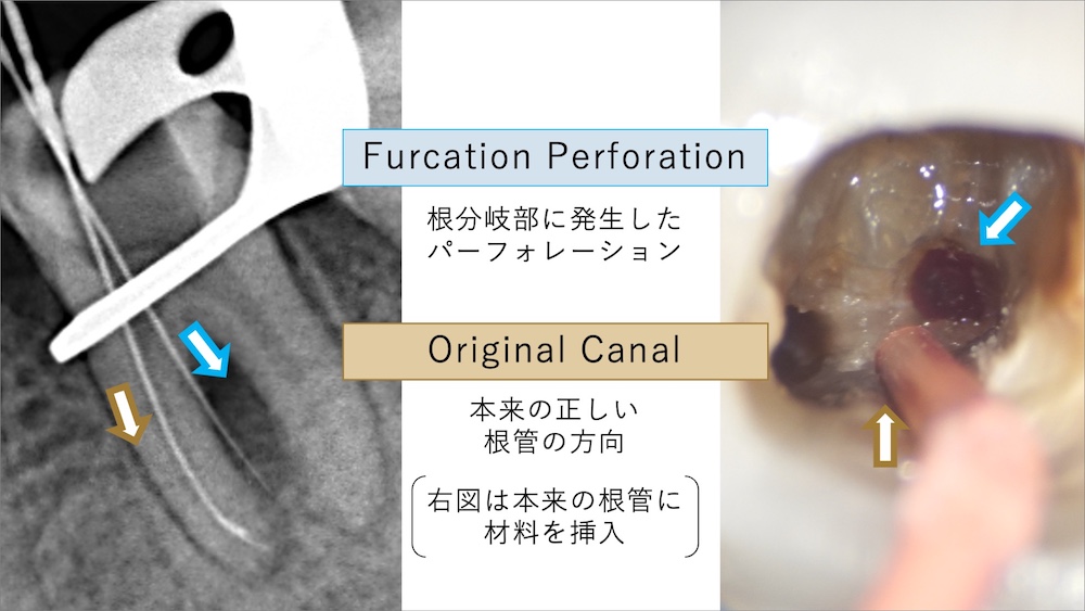 根分岐部（ファーケーション）付近の穿孔