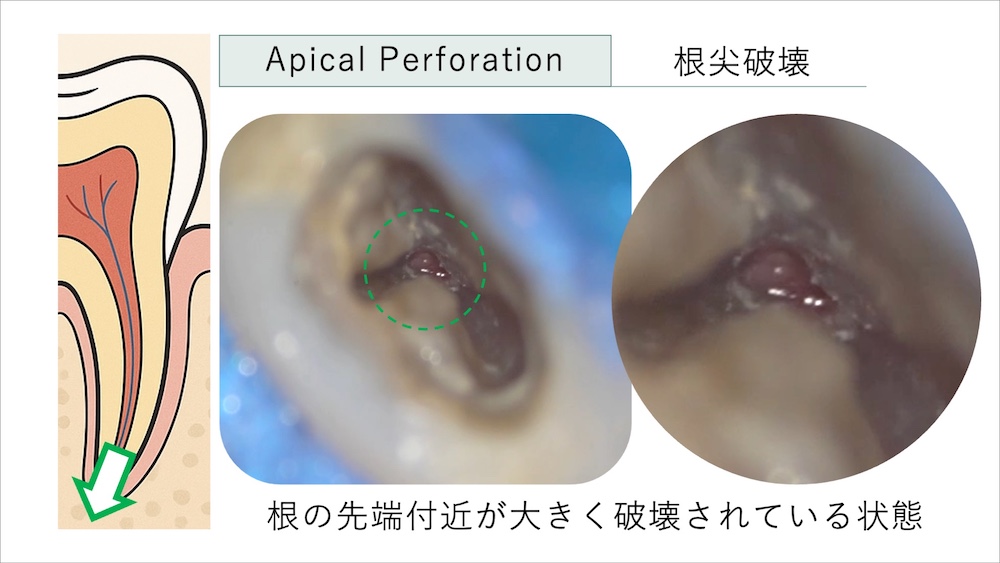 アピカルパーフォレーション（根尖破壊）