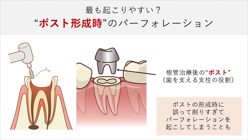 ポスト形成（支台築造）時の穿孔