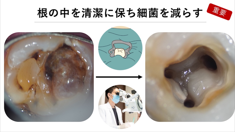 まず大切なのは根管を清潔に保つこと