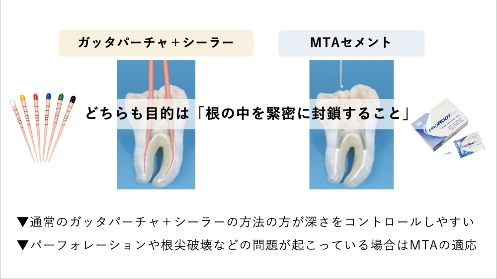image_tooltip ガッタパーチャとの違い:根管充填材としての比較