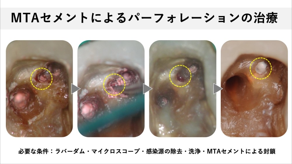 image_tooltip 操作が難しく、術者の技術に結果が左右される