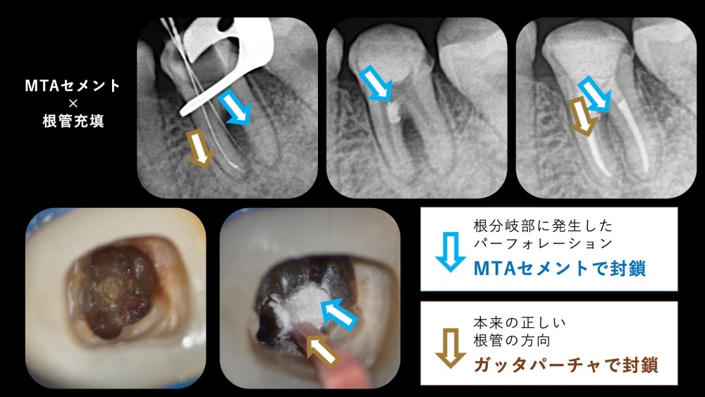 image_tooltip 歯の内部でパーフォレーションが起こっていた歯