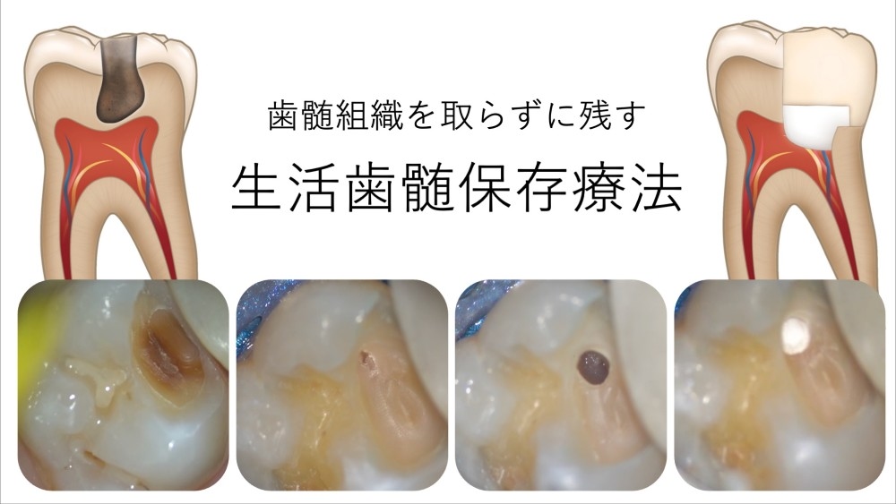 image_tooltip 歯髄温存療法(覆髄)への使用