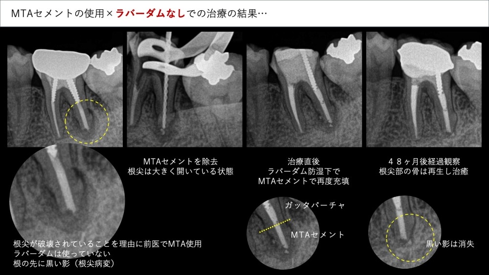 image_tooltip 他院でMTAを入れたが改善しない、という場合