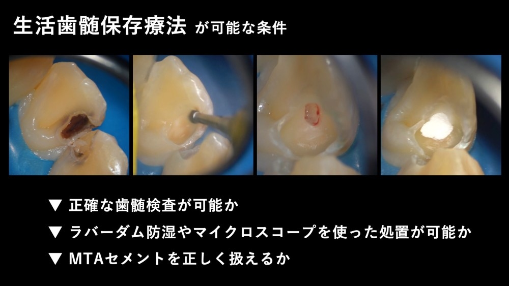 image_tooltip 歯髄保存療法が成立するための条件