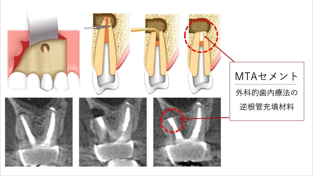 image_tooltip MTAセメント