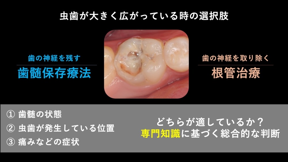 image_tooltip 歯髄温存と抜髄、どちらを選ぶか