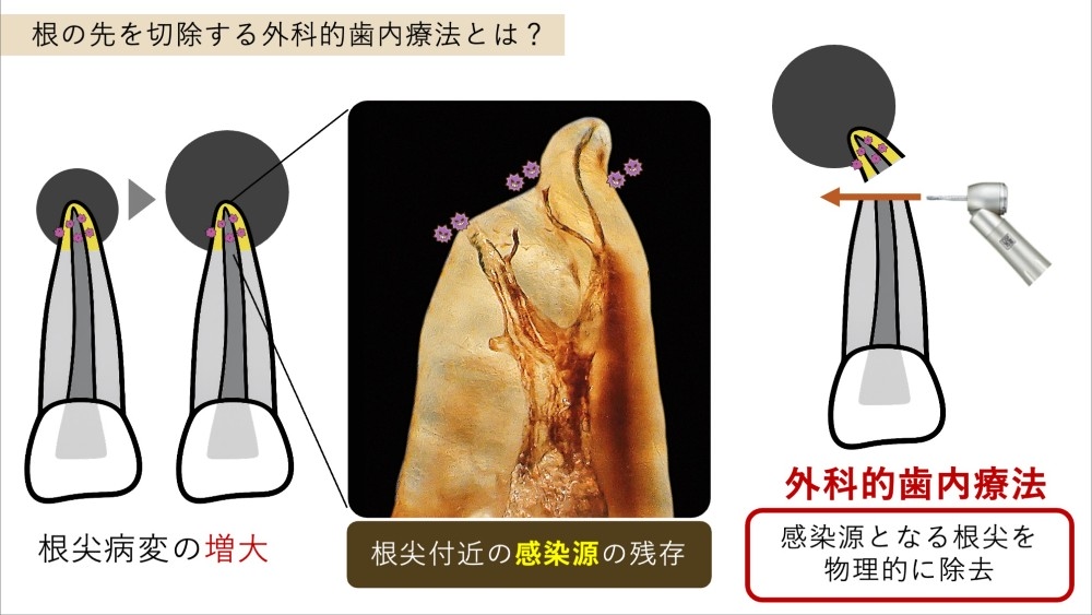 image_tooltip 外科的歯内療法への使用