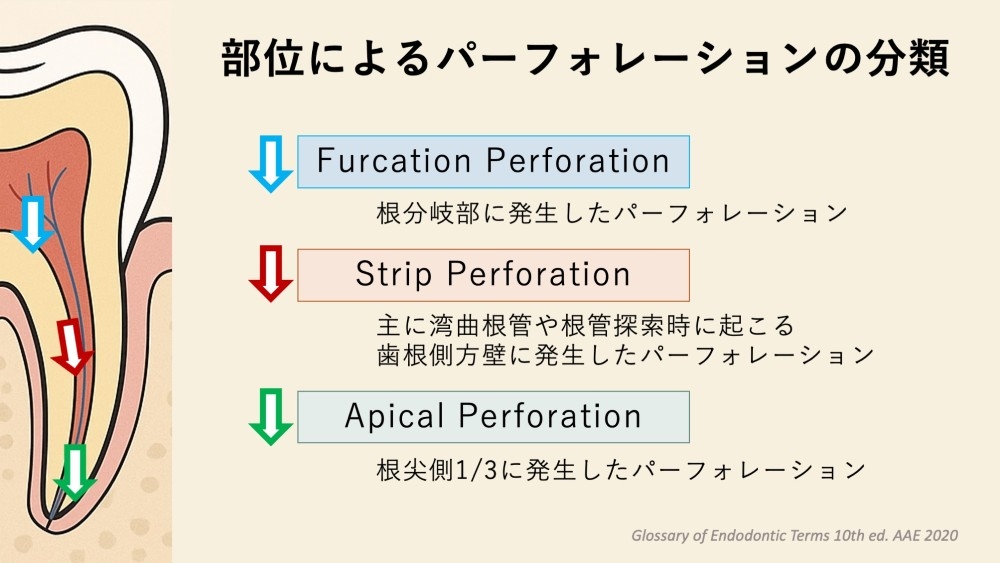 image_tooltip パーフォレーション修復・根尖閉鎖への使用