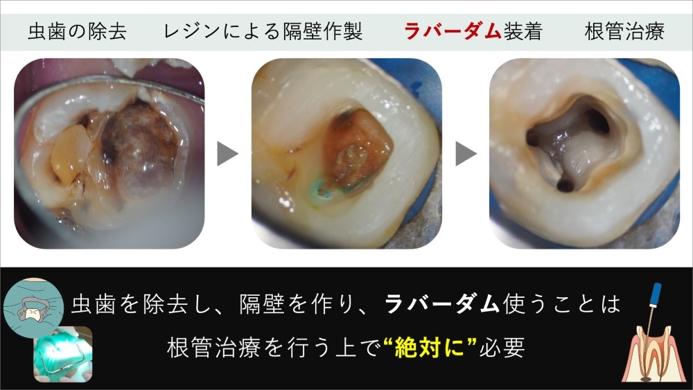 image_tooltip ラバーダムなしの治療にMTAを加えても結果が変わらない理由