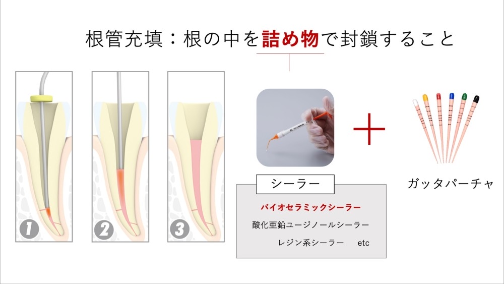 image_tooltip 根管充填への使用
