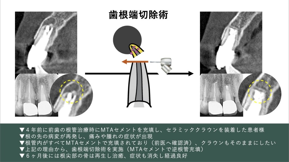 image_tooltip 一度入れると除去が非常に難しい