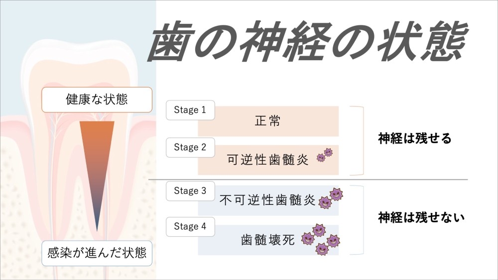 image_tooltip 神経の状態によっては、抜髄の方が長期予後が安定するケースもある