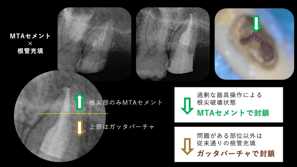 image_tooltip 根尖部が大きく破壊されている状態の歯