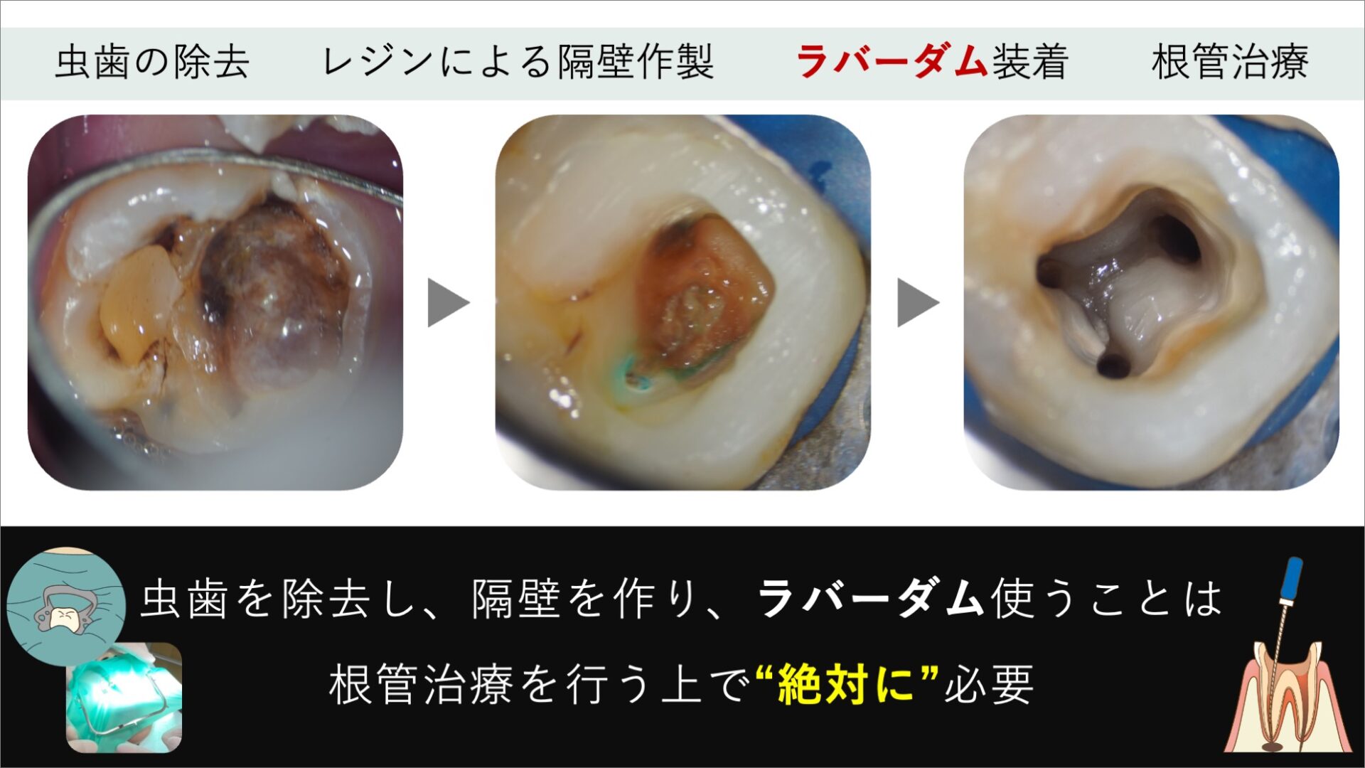 image_tooltip むし歯の取り残し