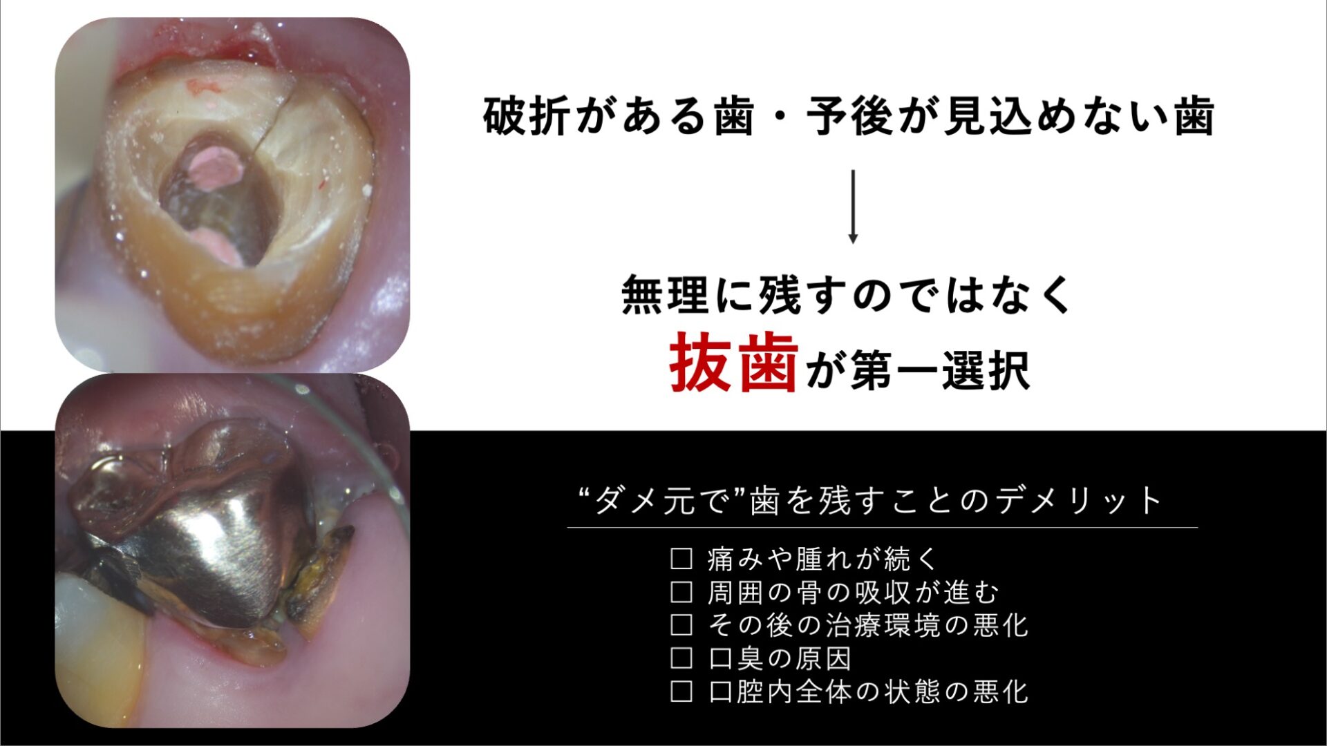 image_tooltip 抜歯という判断