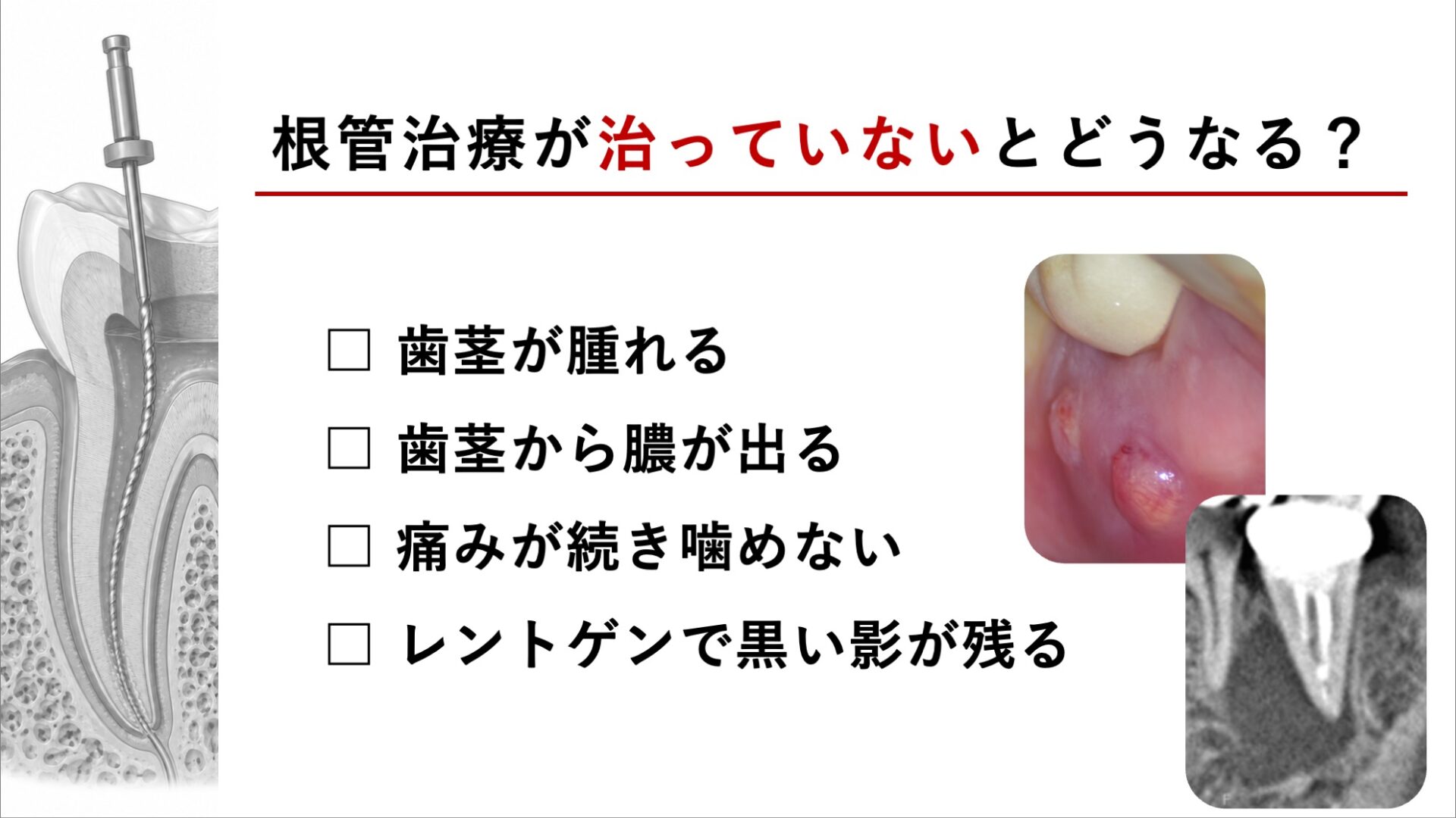 image_tooltip 根管治療が「治らない」とはどういう状態か