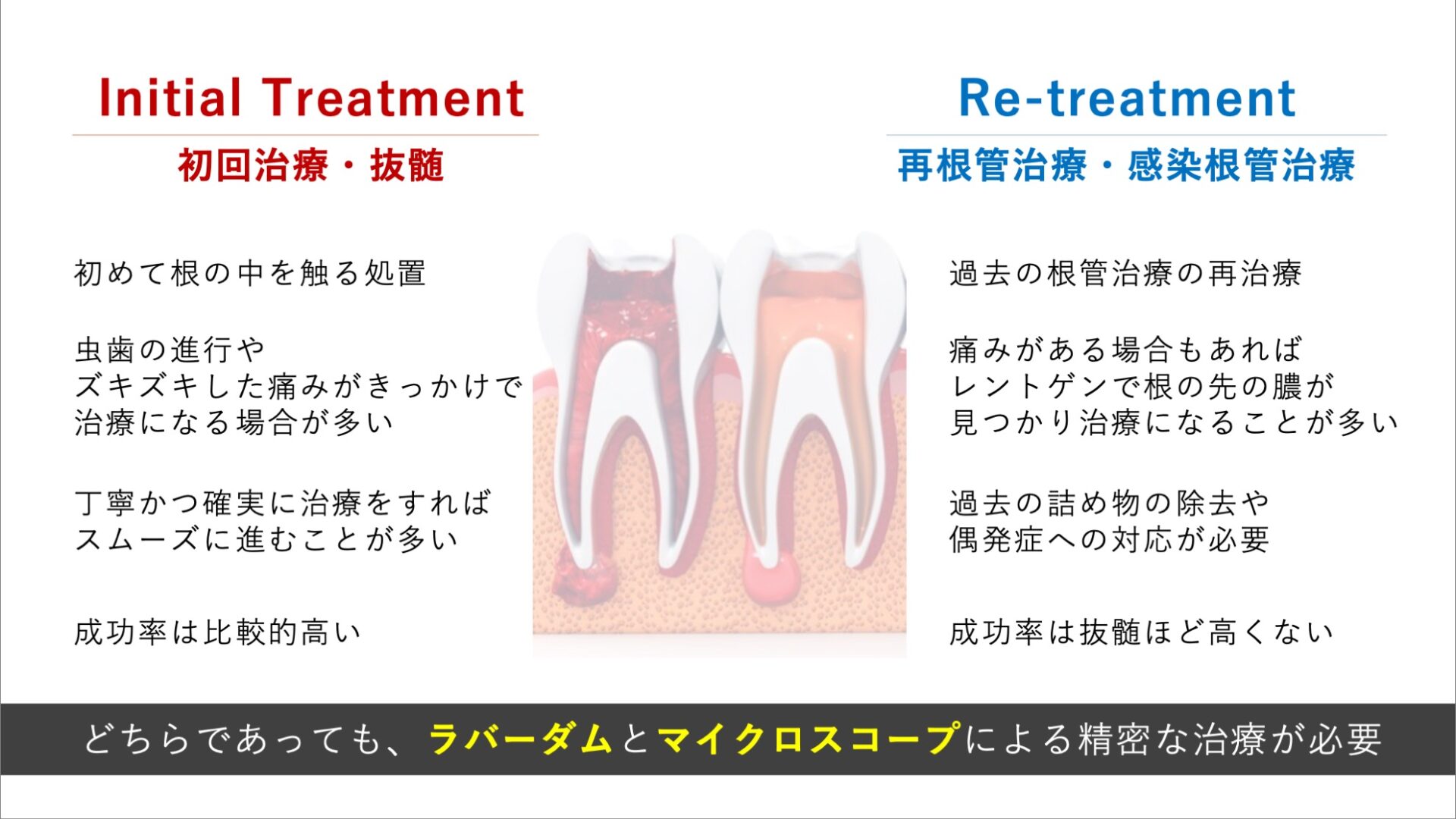 image_tooltip 再根管治療(非外科的歯内療法)