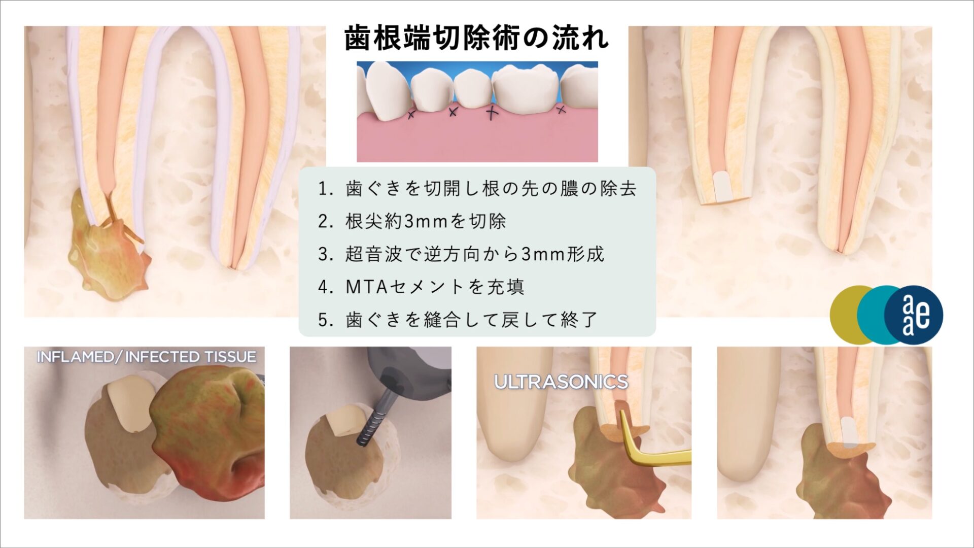 image_tooltip 歯根端切除術の流れ