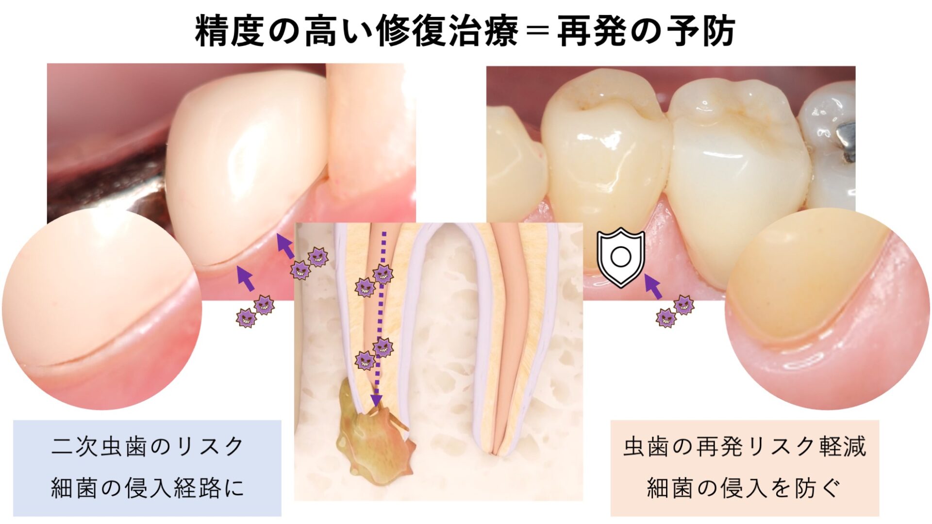 image_tooltip 根管治療後のかぶせ物まで含めて考える
