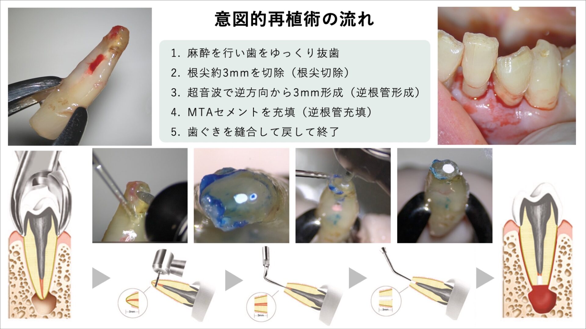 image_tooltip 意図的再植術の流れ