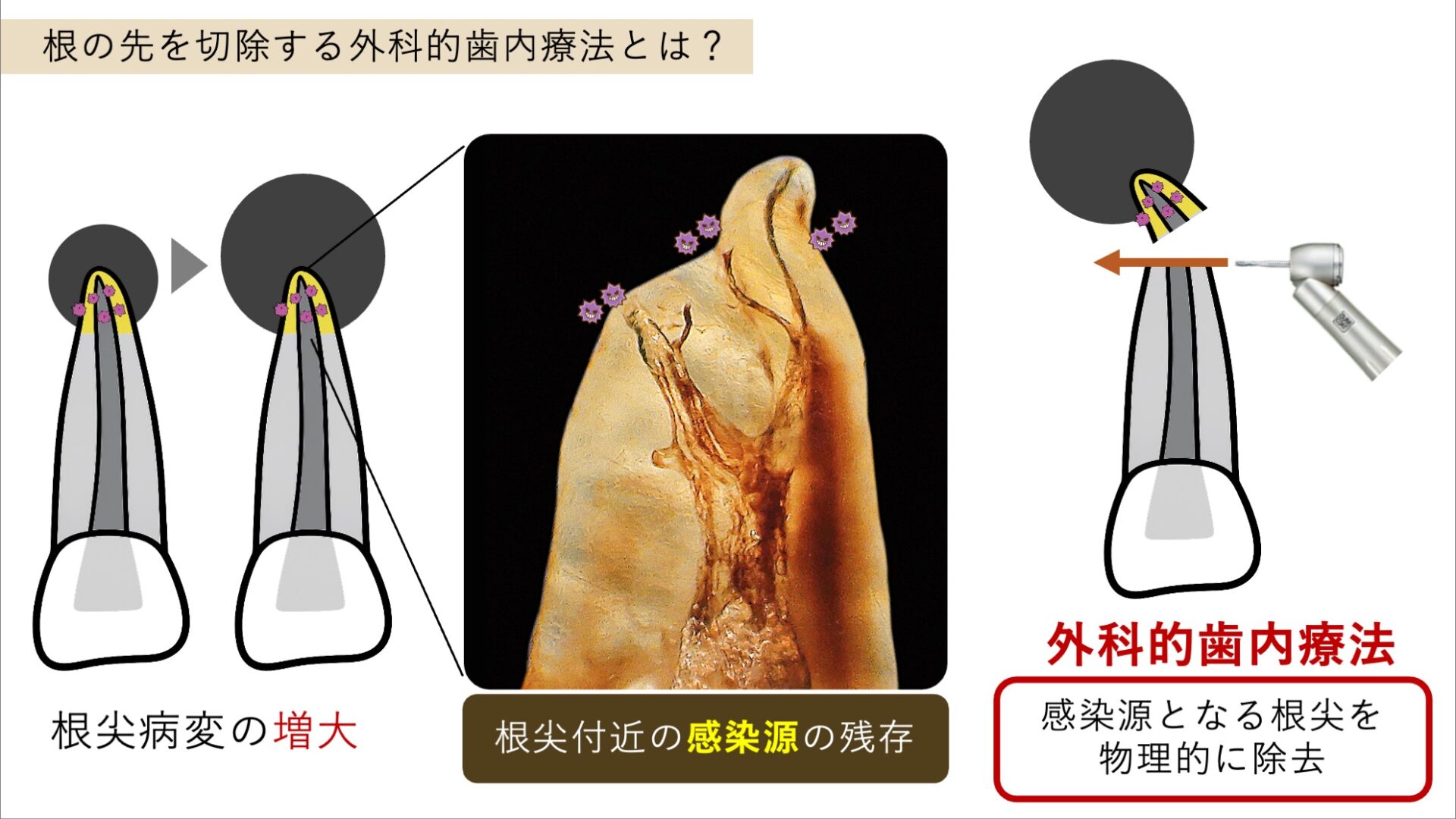 image_tooltip 外科的歯内療法