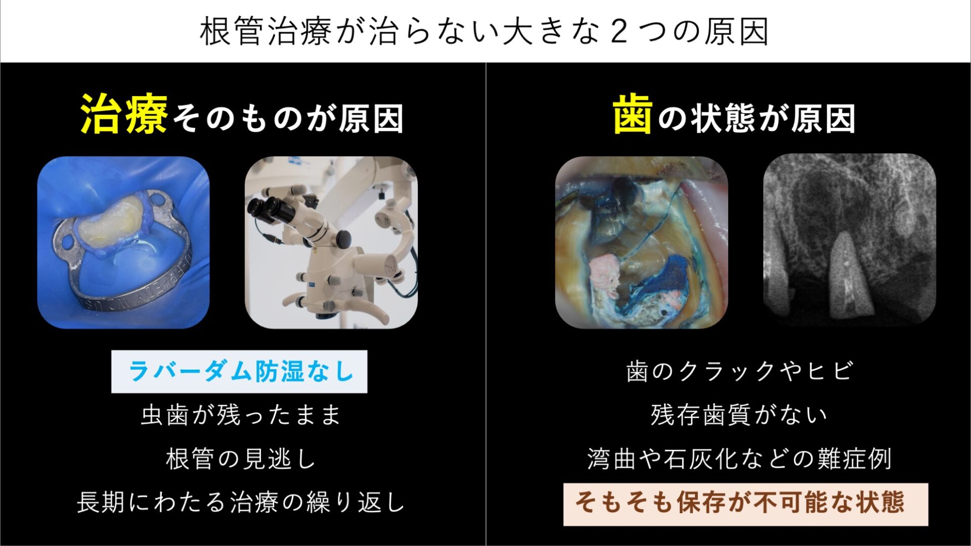image_tooltip 根管治療が治らない場合、その原因は大きく「治療の問題」と「歯そのものの問題」の二つにわけることができます。