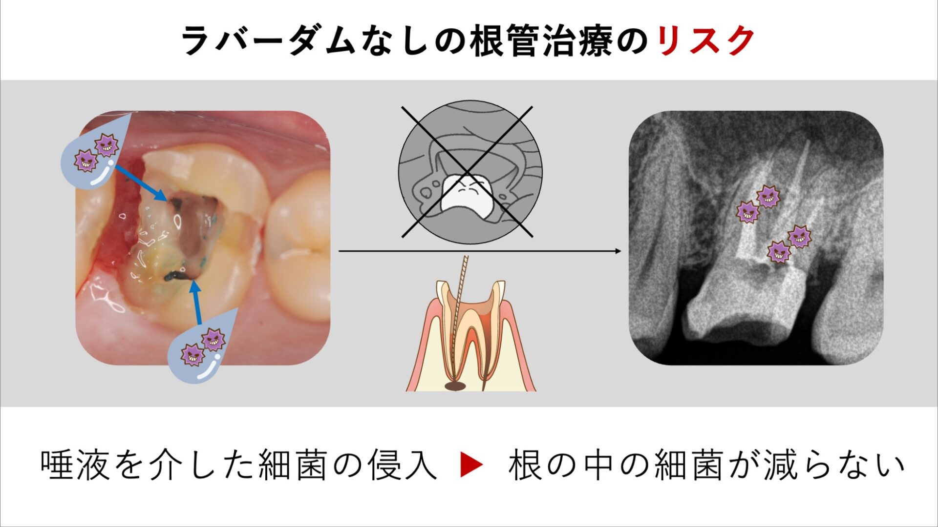 image_tooltip ラバーダム防湿を使わない根管治療