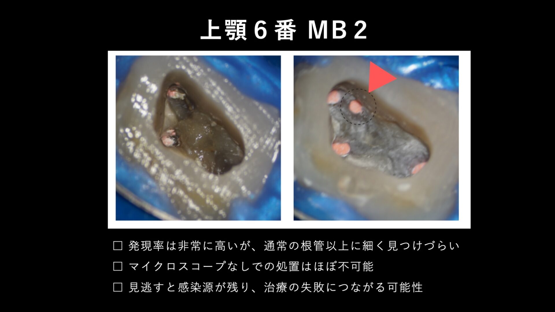 image_tooltip 上顎第一大臼歯に高い頻度で存在するMB2