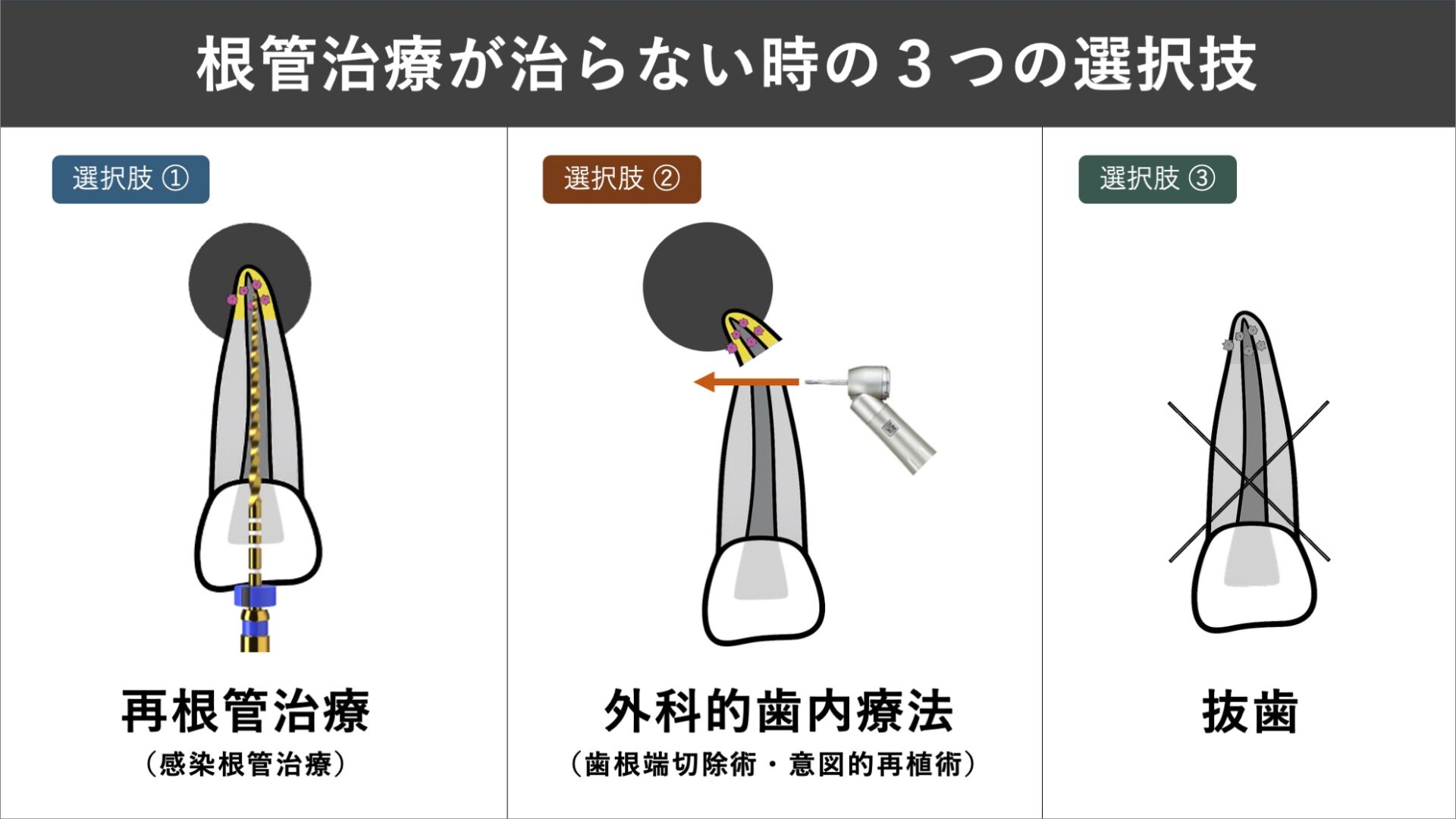 image_tooltip 根管治療が治らないときの治療の選択肢
