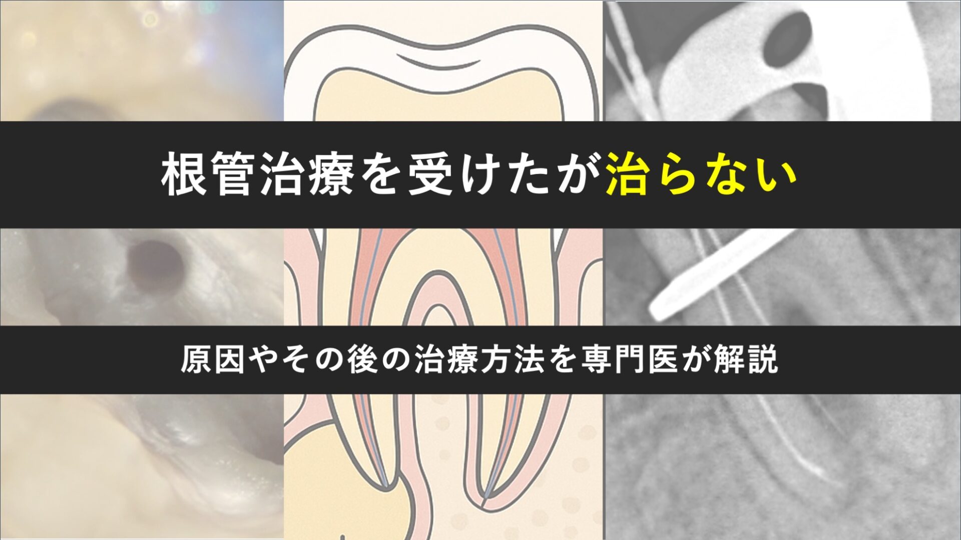 根管治療をした歯が治らない時はどうする？根管治療を受けた歯が治らない原因とその後の治療の選択肢を解説