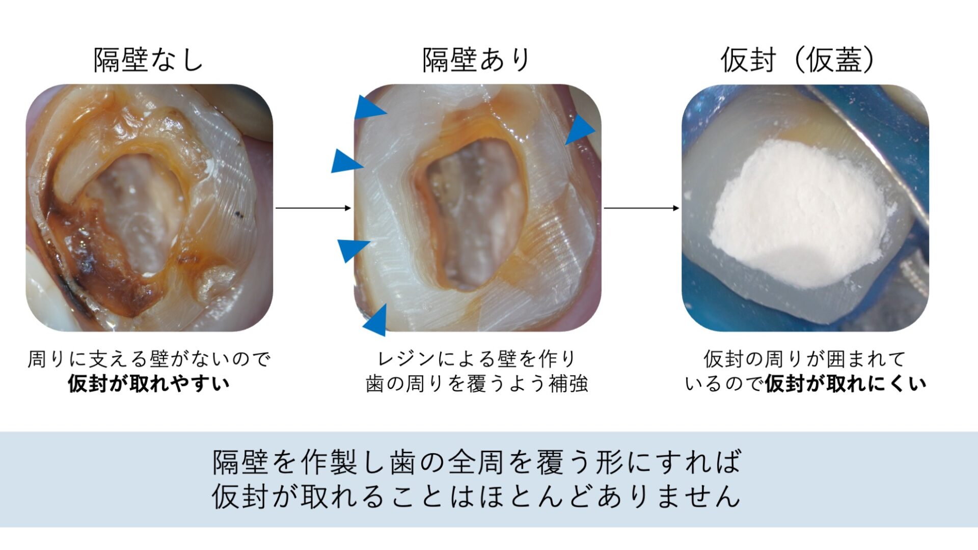 image_tooltip 隔壁を作る前にむし歯を取り切る必要がある